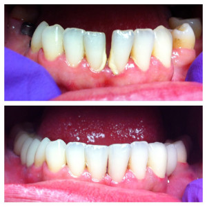 Pacijentica nije željela brusiti donje centralne sjekutiće, niti ortodontsku terapiju, stoga joj je diastema zatvorena kompozitnim materijalom, a boja zuba korigirana izbjeljivanjem. Nedostatak zuba u stražnjoj regiji riješen je protetski.