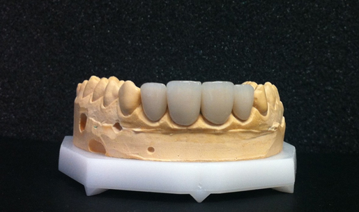 stomatolog-patricia-keramicke-zubne-ljuskice