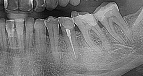 ENDODONCIJA-1