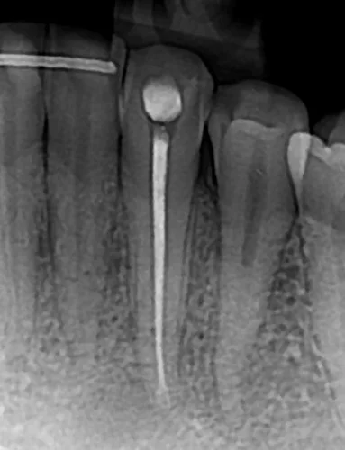 ENDODONCIJA-2-1