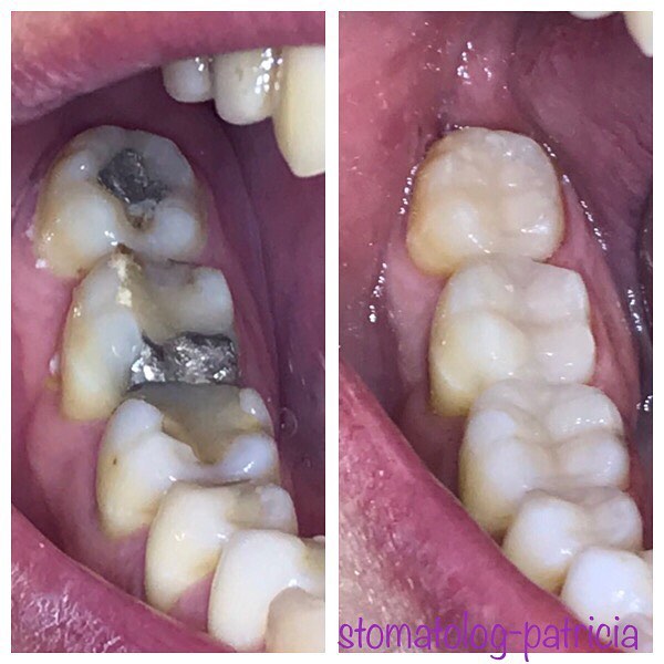 BIJELE-ESTETSKE-PLOMBE-1