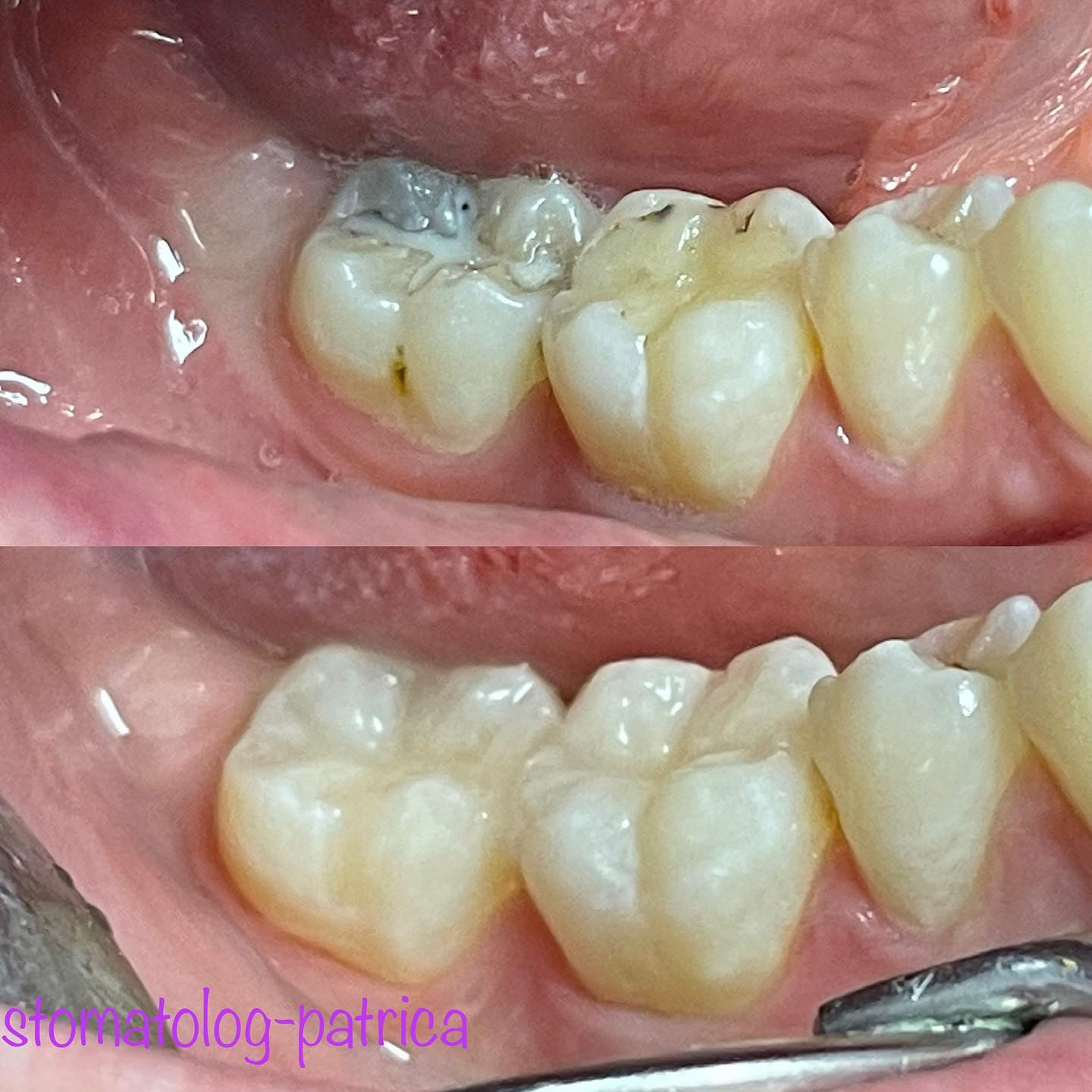 BIJELE-ESTETSKE-PLOMBE-3