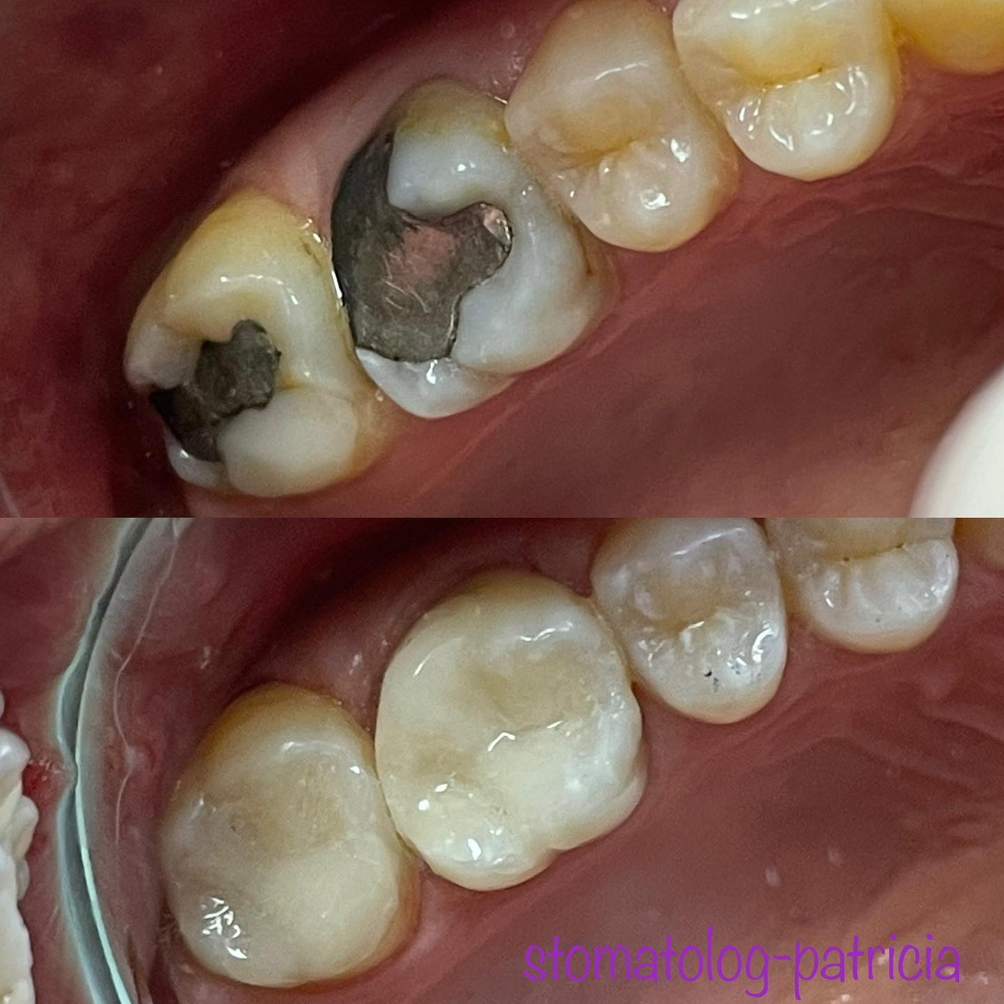 BIJELE-ESTETSKE-PLOMBE-4