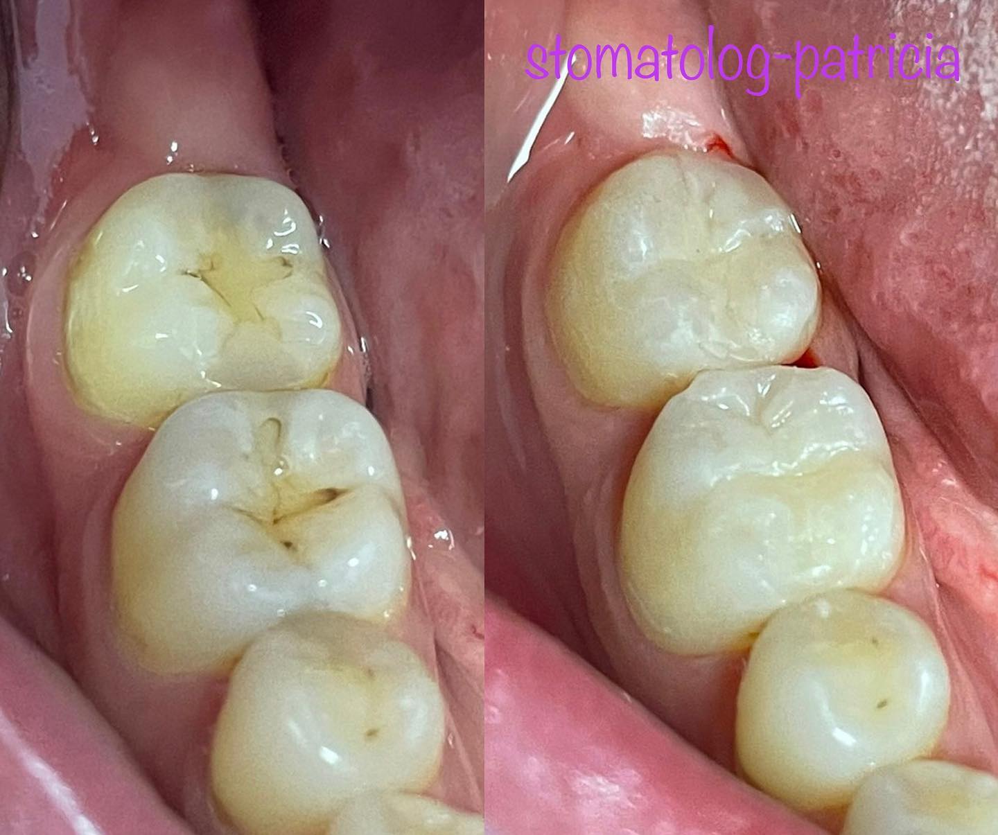 BIJELE-ESTETSKE-PLOMBE-5